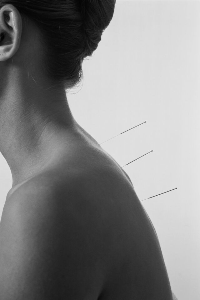 Acupuntura en SanaVida Salud Integral