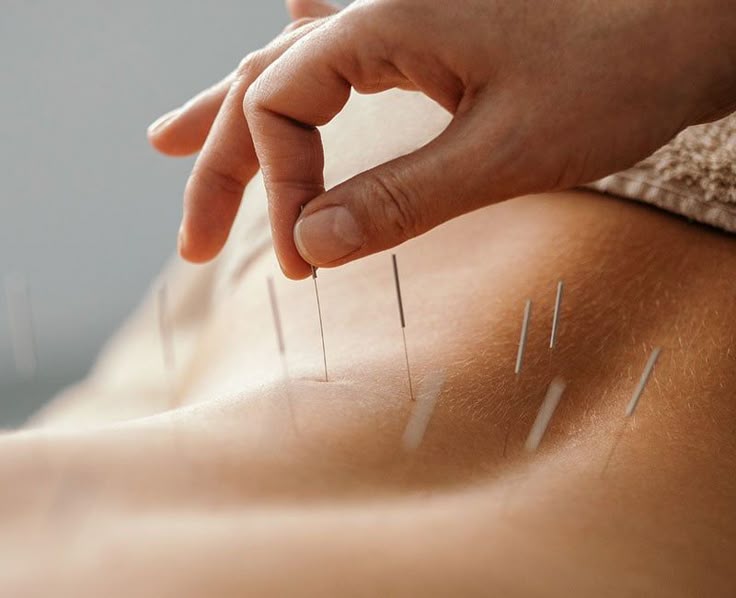 Acupuntura