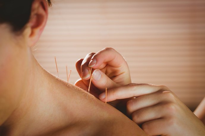 Acupuntura