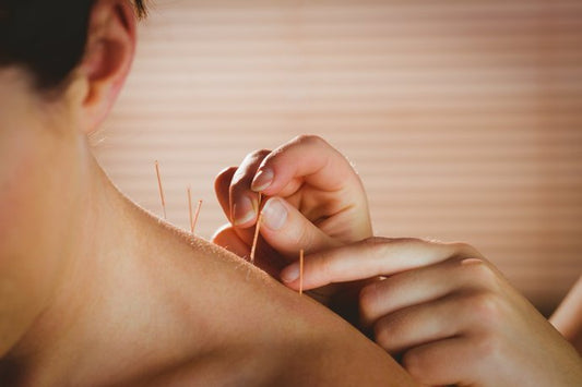 Acupuntura